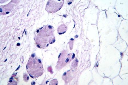 Skeletal muscle atrophy, photomicrograph showing decreased fiber size with increased spacing between them, reduced myofibrils, increased endomysial connective tissue with fatty infiltration.の写真素材