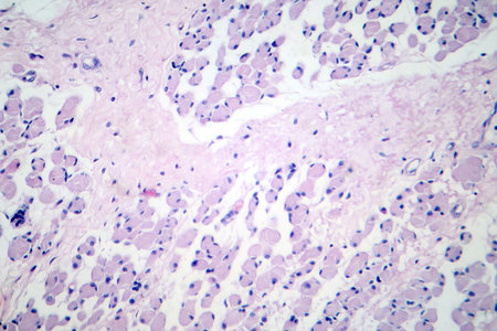 Skeletal muscle atrophy, photomicrograph showing decreased fiber size with increased spacing between them, reduced myofibrils, increased endomysial connective tissue with fatty infiltration.の写真素材
