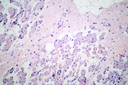 Skeletal muscle atrophy, photomicrograph showing decreased fiber size with increased spacing between them, reduced myofibrils, increased endomysial connective tissue with fatty infiltration.の写真素材