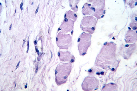 Skeletal muscle atrophy, photomicrograph showing decreased fiber size with increased spacing between them, reduced myofibrils, and increased endomysial connective tissue.の写真素材