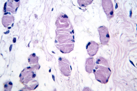 Skeletal muscle atrophy, photomicrograph showing decreased fiber size with increased spacing between them, reduced myofibrils, and increased endomysial connective tissue.の写真素材