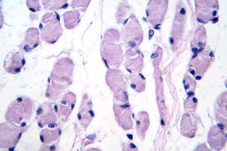 Skeletal muscle atrophy, photomicrograph showing decreased fiber size with increased spacing between them, reduced myofibrils, and increased endomysial connective tissue.の写真素材