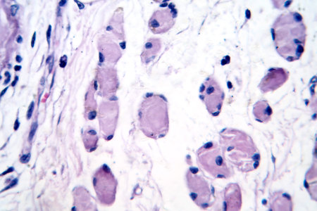 Skeletal muscle atrophy, photomicrograph showing decreased fiber size with increased spacing between them, reduced myofibrils, increased endomysial connective tissue with fatty infiltration.の写真素材