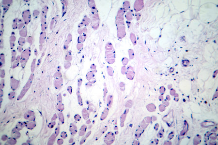 Skeletal muscle atrophy, photomicrograph showing decreased fiber size with increased spacing between them, reduced myofibrils, and increased endomysial connective tissue.の写真素材