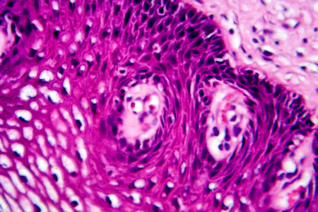 Atypical squamous epithelial hyperplasia, photomicrograph showing thickened stratified epithelium with nuclear atypia and basal layer crowding.の写真素材