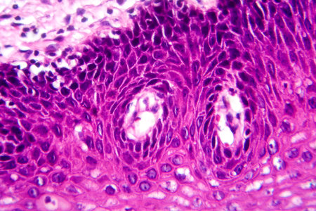 Atypical squamous epithelial hyperplasia, photomicrograph showing thickened stratified epithelium with nuclear atypia and basal layer crowding.の写真素材