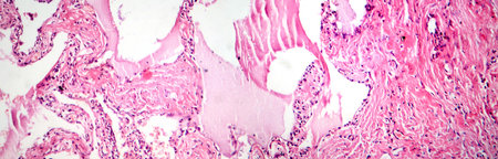 Red hepatization stage of lobar pneumonia, photomicrograph showing alveolar exudate with red cells, neutrophils, and fibrin strands.の写真素材
