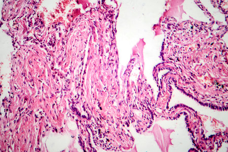 Red hepatization stage of lobar pneumonia, photomicrograph showing alveolar exudate with red cells, neutrophils, and fibrin strands.の写真素材