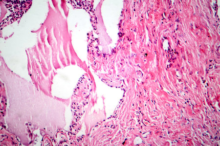 Red hepatization stage of lobar pneumonia, photomicrograph showing alveolar exudate with red cells, neutrophils, and fibrin strands.の写真素材