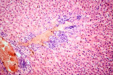 Coccidia in liver, photomicrograph showing intracellular parasitic protozoa causing hepatic coccidiosis with inflammation and hepatocellular damage.の写真素材