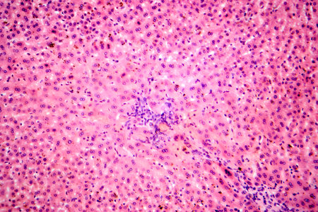 Coccidia in liver, photomicrograph showing intracellular parasitic protozoa causing hepatic coccidiosis with inflammation and hepatocellular damage.の写真素材