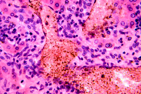 Coccidia in liver, photomicrograph showing intracellular parasitic protozoa causing hepatic coccidiosis with inflammation and hepatocellular damage.の写真素材