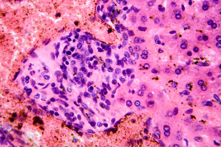 Coccidia in liver, photomicrograph showing intracellular parasitic protozoa causing hepatic...