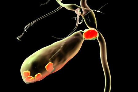Mirizzi syndrome, 3D illustration showing compression of the common hepatic duct by an impacted...