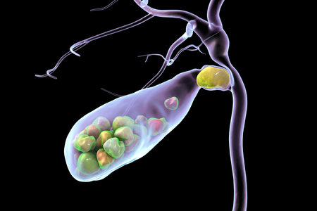 Gallbladder with stones, 3D illustration showing cholelithiasis. Gallstones can block bile flow and cause pain, inflammation, or infection requiring medical or surgical treatment.の写真素材