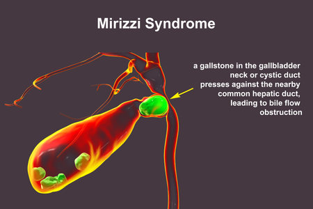 Mirizzi syndrome, 3D illustration showing compression of the common hepatic duct by an impacted gallstone in the cystic duct, causing obstructive jaundice and inflammation.の写真素材