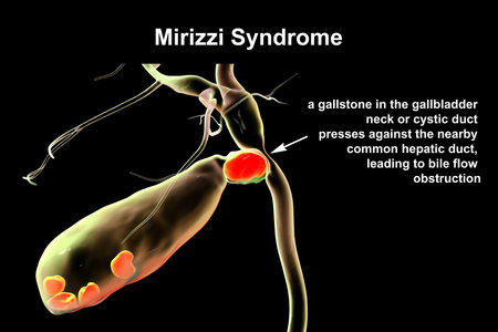 Mirizzi syndrome, 3D illustration showing compression of the common hepatic duct by an impacted gallstone in the cystic duct, causing obstructive jaundice and inflammation.の写真素材
