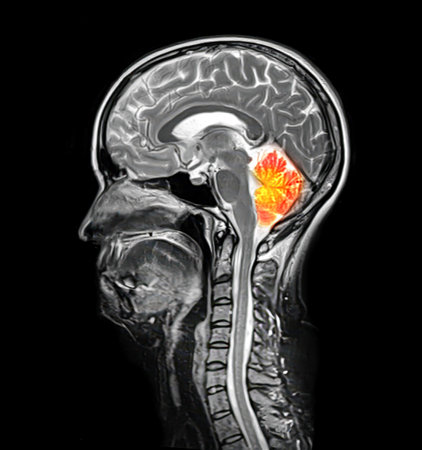 Cerebellum highlighted in colored composite image of MRI scan of the brain from a 44-year-old patient, showing structure involved in balance, coordination, and motor control.の写真素材