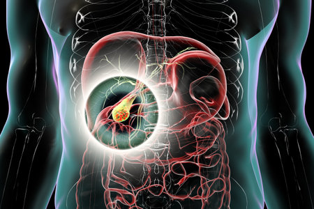 Gallbladder with stones, 3D illustration showing cholelithiasis. Gallstones can block bile flow and cause pain, inflammation, or infection requiring medical or surgical treatment.の写真素材