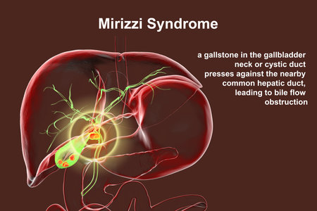 Mirizzi syndrome, 3D illustration showing compression of the common hepatic duct by an impacted gallstone in the cystic duct, causing obstructive jaundice and inflammation.の写真素材