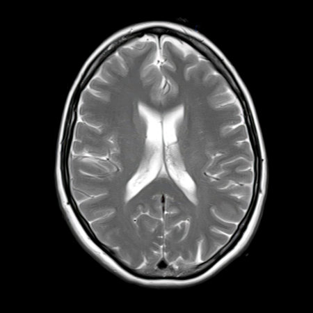Axial T2-weighted MRI of a 40-year-old showing normal lateral ventricles, corpus callosum, and...