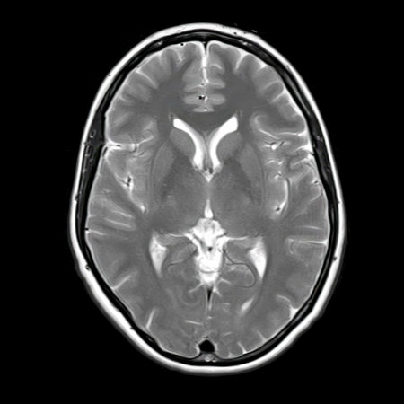 Axial T2-weighted brain MRI of a 40-year-old showing normal anatomy of lateral ventricles, thalamus,...