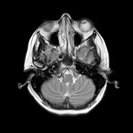 T2-weighted axial MRI scan of a 40-year-old patient showing cerebellum, orbits, nasal cavity, and...