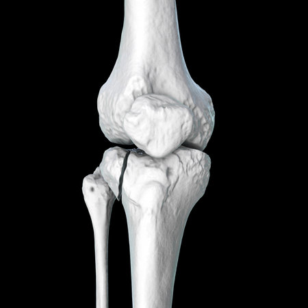 Tibia fracture Schatzker type I, 3D illustration showing lateral tibial plateau split fracture...