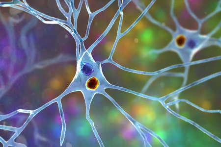 Lewy body dementia, 3D illustration showing neurons with Lewy bodies - abnormal alpha-synuclein...