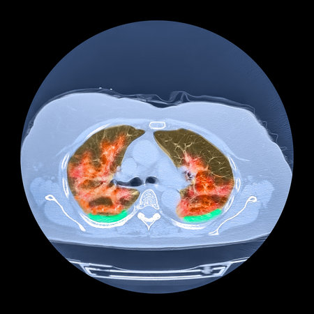 Colored computed tomography (CT) scan of human lungs affected by Covid-19 pneumonia showing...