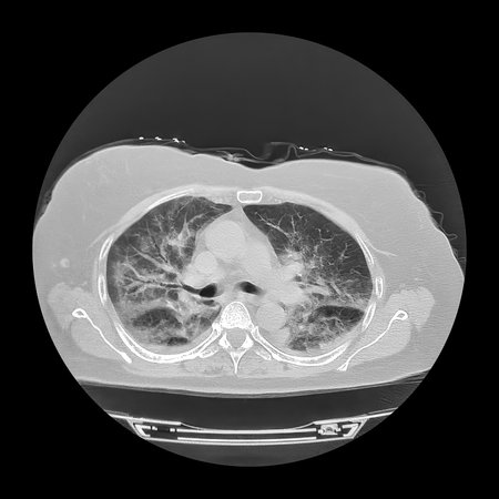 Computed tomography (CT) scan of human lungs (axial view) affected by Covid-19 pneumonia showing...