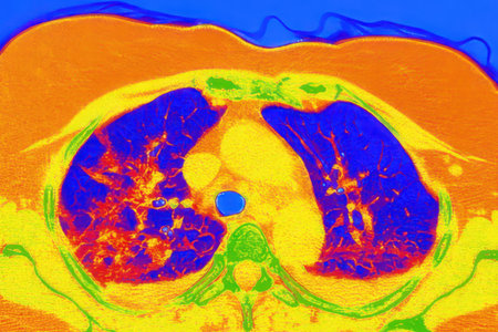 Human lungs with COVID-19 pneumonia, color-enhanced CT scan showing normal lung tissue in blue and affected bilateral areas with ground-glass opacities and crazy-paving patterns in orange-red.の写真素材