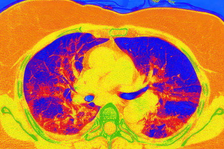 Human lungs with COVID-19 pneumonia, color-enhanced CT scan showing normal lung tissue in blue and affected bilateral areas with ground-glass opacities and crazy-paving patterns in orange-red.の写真素材