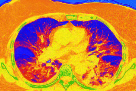 Human lungs with COVID-19 pneumonia, color-enhanced CT scan showing normal lung tissue in blue and affected bilateral areas with ground-glass opacities and crazy-paving patterns in orange-red.の写真素材