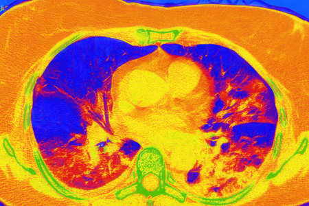 Human lungs with COVID-19 pneumonia, color-enhanced CT scan showing normal lung tissue in blue and affected bilateral areas with ground-glass opacities and crazy-paving patterns in orange-red.の写真素材