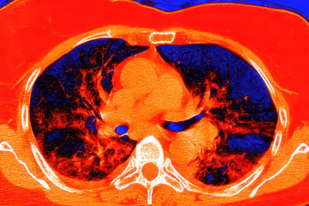 Human lungs with COVID-19 pneumonia, color-enhanced CT scan showing normal lung tissue in dark blue and affected bilateral areas with ground-glass opacities and crazy-paving patterns in red.の写真素材