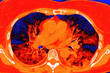 Human lungs with COVID-19 pneumonia, color-enhanced CT scan showing normal lung tissue in dark blue and affected bilateral areas with ground-glass opacities and crazy-paving patterns in red.の写真素材
