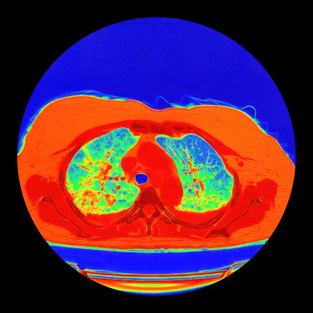 Human lungs with COVID-19 pneumonia, color-enhanced CT scan showing normal lung tissue in blue-green and affected bilateral areas with ground-glass opacities and crazy-paving patterns in orange-red.の写真素材