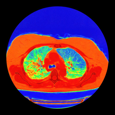 Human lungs with COVID-19 pneumonia, color-enhanced CT scan showing normal lung tissue in blue-green and affected bilateral areas with ground-glass opacities and crazy-paving patterns in orange-red.の写真素材