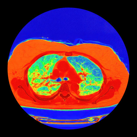 Human lungs with COVID-19 pneumonia, color-enhanced CT scan showing normal lung tissue in blue-green and affected bilateral areas with ground-glass opacities and crazy-paving patterns in orange-red.の写真素材