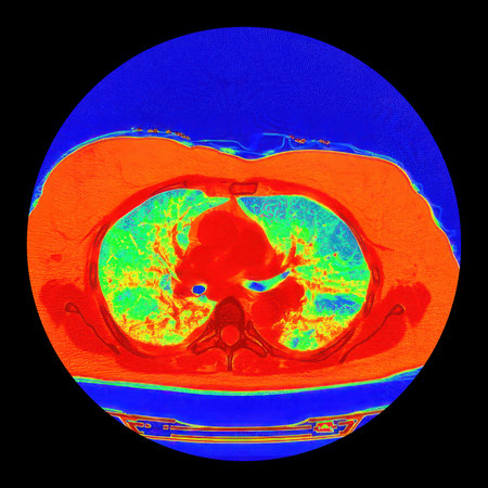 Human lungs with COVID-19 pneumonia, color-enhanced CT scan showing normal lung tissue in blue-green and affected bilateral areas with ground-glass opacities and crazy-paving patterns in orange-red.の写真素材
