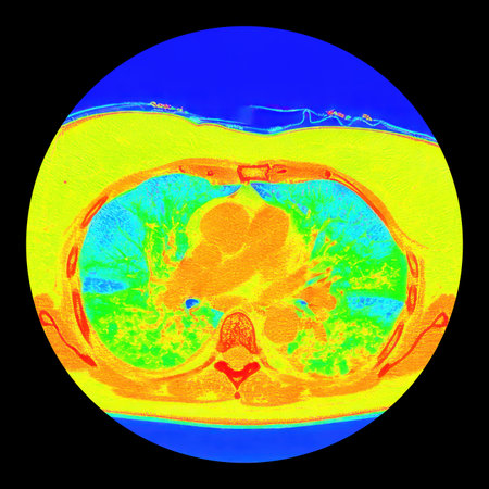 Human lungs with COVID-19 pneumonia, color-enhanced CT scan showing normal lung tissue in blue and affected bilateral areas with ground-glass opacities and crazy-paving patterns in green to yellow.の写真素材
