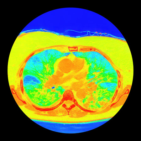 Human lungs with COVID-19 pneumonia, color-enhanced CT scan showing normal lung tissue in blue and affected bilateral areas with ground-glass opacities and crazy-paving patterns in green to yellow.の写真素材