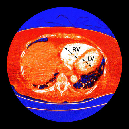 Color-enhanced CT scan showing right ventricular strain in a patient with pulmonary embolism, showing right ventricular enlargement and flattening of the interventricular septum. Labelled version.の写真素材