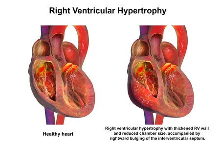 Healthy heart compared with right ventricular hypertrophy, 3D illustration. Thickened RV wall occurs in pulmonary hypertension or congenital defects, raising failure and arrhythmia risk.の写真素材