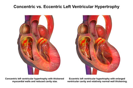 Concentric vs eccentric left ventricular hypertrophy, 3D illustration showing thickened symmetric LV wall in pressure overload compared with dilated LV chamber and thinner wall in volume overload, highlighting clinical implications.の写真素材