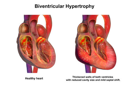 Healthy heart vs biventricular hypertrophy, 3D illustration showing normal ventricular walls compared with simultaneous thickening of the left and right ventricles.の写真素材