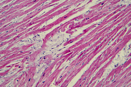 Photomicrograph of cardiac hypertrophy showing enlarged and thickened cardiac muscle fibers under the microscope.の写真素材