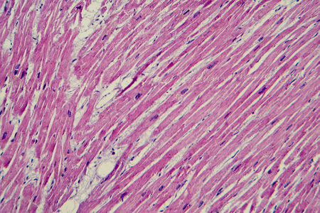 Photomicrograph of cardiac hypertrophy showing enlarged and thickened cardiac muscle fibers under the microscope.の写真素材