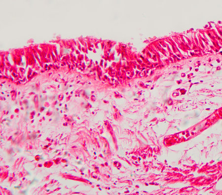 Photomicrograph of bronchial epithelial squamous metaplasia, showing squamous cell transformation in...